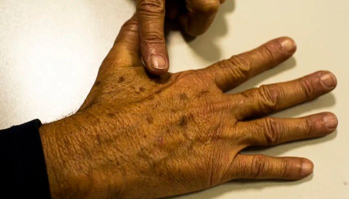  Câncer de pele gera R$ 4,6 mi em custos hospitalares em quase 2 anos 